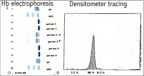 <p>The hemoglobin electrophoresis pattern for patient #2 shows an increase in Hb F and a decrease in both Hb A and Hb A2. These results correlate best with which of these thalassemias?</p><p></p><p>Beta thalassemia minor</p><p>Beta thalassemia major</p><p>Delta-beta thalassemia minor</p><p>Alpha thalassemia major</p>