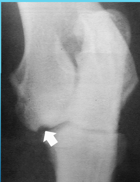 <p>what is this on the medial condyle of humerus?</p>