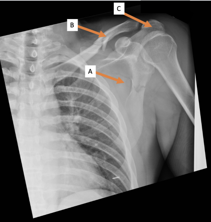 <p>B. Identify the bone</p>