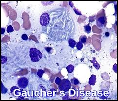 <ul><li><p>a rare genetic disorder of <strong>monocytes and macrophages</strong></p></li><li><p>alpha-glucocerebrosidase deficiency</p><ul><li><p>an enzyme that splits glucose from glucosylceramide in cells</p></li><li><p>causes an <u>accumulation of cerebroside</u></p></li></ul></li><li><p>found in <strong>bone marrow</strong> but NOT in <strong>peripheral blood smears</strong></p><ul><li><p><u>cells are large, have 1-3 eccentric nuclei, and wrinkled cytoplasm</u></p></li></ul></li><li><p><strong>types:</strong></p><ul><li><p>type 1: most organs are involved, but not the brain</p></li><li><p>type 2: brain involved</p></li></ul></li><li><p>some patients can live a possibly normal life while others have premature deaths</p></li></ul><p></p>