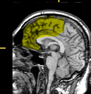 <p>What lobe of the brain is highlighted?</p>