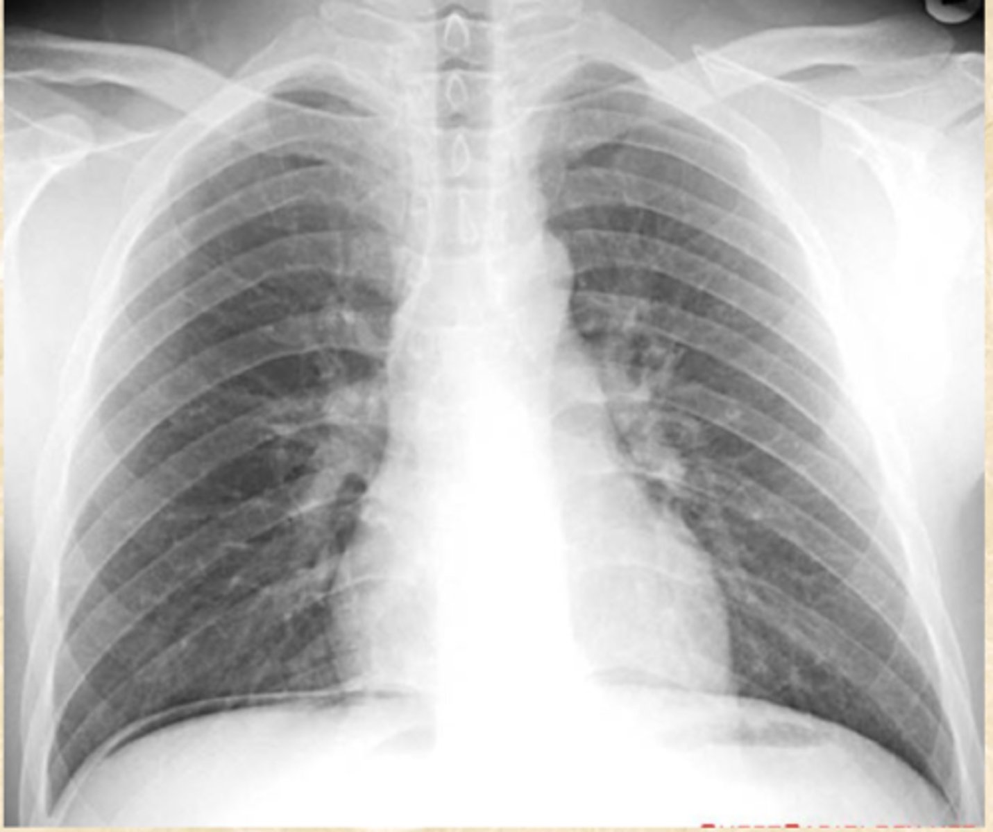 <p>What does this CXR show?</p>