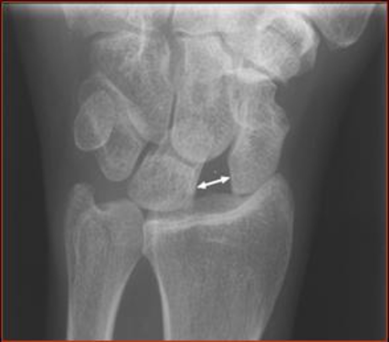 <p>scapholunate dislocation</p>
