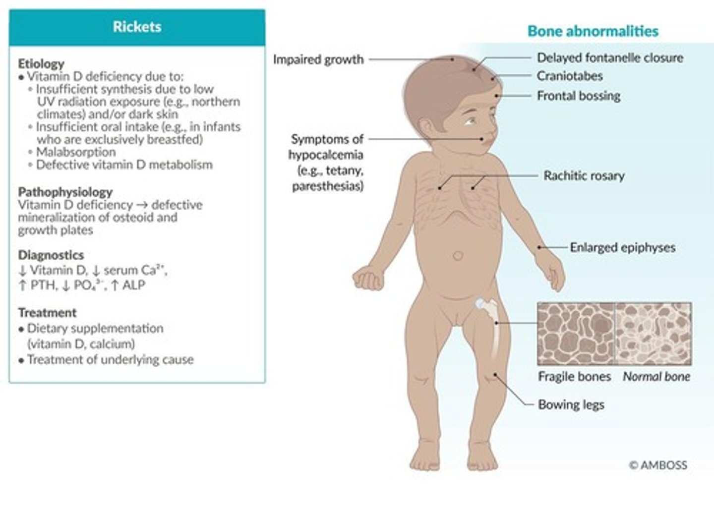 <p>Childhood bone softening, characterized by bowed legs.</p>