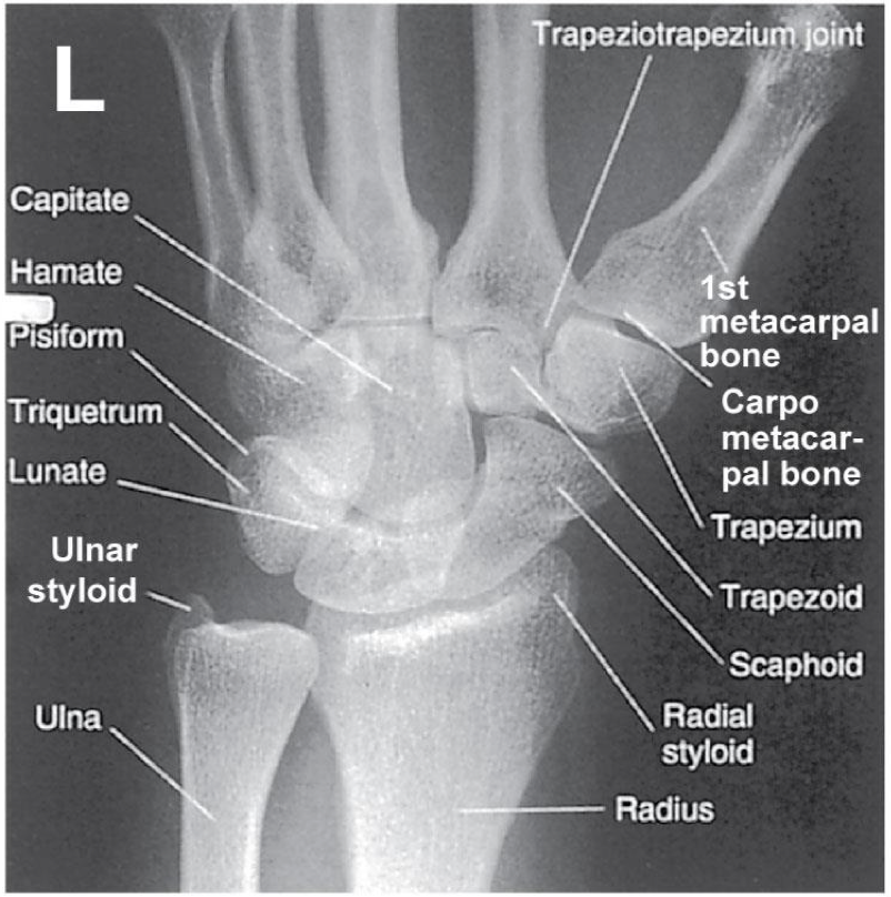 <p><span style="line-height: normal;">• </span>Distal radius/ ulna and carpals demonstrated</p><p class="p1"><span style="line-height: normal;">• </span>Ulnar styloid process in profile</p><ul><li><p class="p1"><span style="line-height: normal;"> </span>If humerus is not abducted &amp; elbow flexed: the ulnar styloid process will not be in profile</p></li></ul><p class="p1"><span style="line-height: normal;">• </span>Open (or near open) radioulnar joint</p><p class="p1"><span style="line-height: normal;">• </span>Center of field at midcarpals</p><p class="p1"><span style="line-height: normal;">• </span>Long axis of 3<span style="line-height: normal;">rd</span> metacarpal in line with long axis of forearm</p><p class="p1"><span style="line-height: normal;">• </span>No rotation</p><p class="p1"><span style="line-height: normal;">• </span>Exposure factors</p><ul><li><p class="p1"><span style="line-height: normal;"> </span>Good soft tissue</p></li><li><p class="p1"><span style="line-height: normal;"> </span>Should demonstrate scaphoid fat stripe</p></li></ul><p></p>