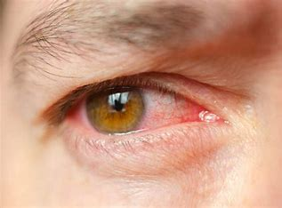 <p>What condition of the eyes is characterized by increased ocular pressure or damage to the optic nerve?</p>