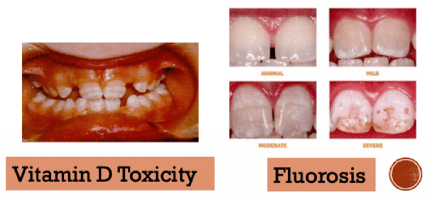 <p>Would the following be caused by overnutrition or undernutrition?</p><p>- Fluorosis</p><p>- Vitamin D toxicity</p><p>- Vitamin A toxicity</p>