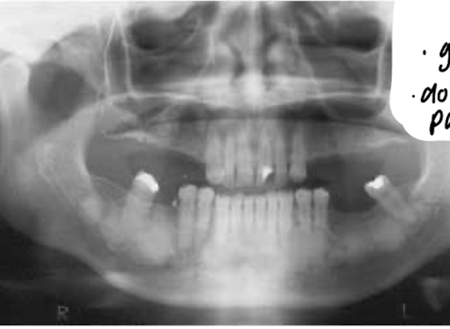 <p>- Multiple quads</p><p>- Looks like cotton wool</p><p>- Good OHI and cleanings</p><p>- Do not go into lesion bc poorly vascularized</p><p>- Poor oxygenation to tissues</p>