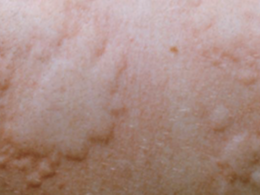 <p>a rounded or flat-topped pale papule/plaque that disappears in 48 hours; due to edema of the dermis</p>