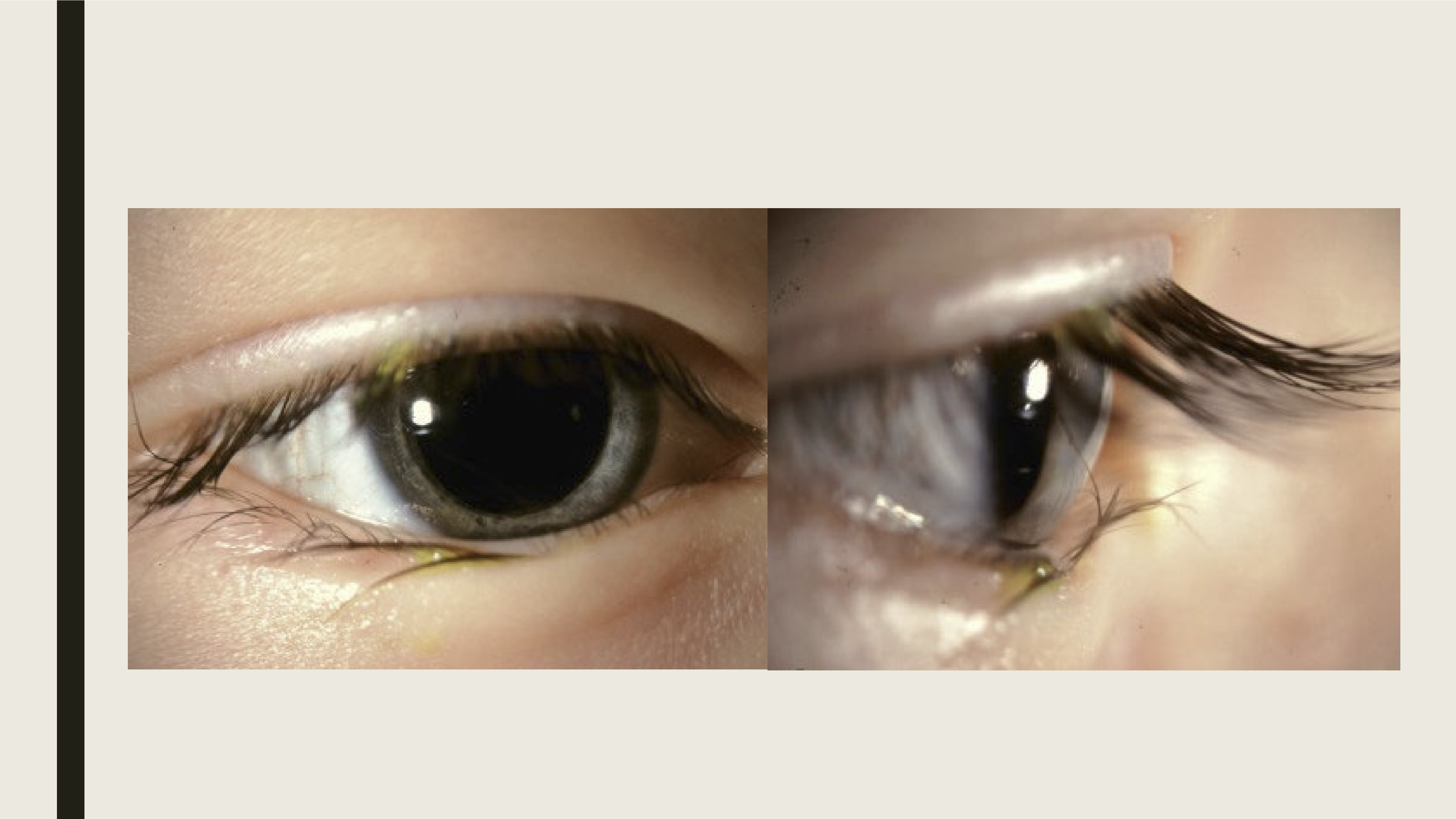 <p>Horizontal fold of skin that covers the eyelid margin, typically due to hypertrophic orbicularis oculi muscle. This causes the eyelashes to rotate towrads the globe, giving the appearance of entropion. </p>