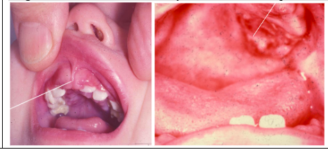 <p><span style="background-color: transparent; font-family: "Times New Roman", serif;"><strong>*Ulcerated gingival lesions </strong></span></p><p><span style="background-color: transparent; font-family: "Times New Roman", serif;"><strong>*Diffuse bone destruction with loss of teeth</strong></span></p><p><span style="background-color: transparent; font-family: "Times New Roman", serif;">*Significant oral involvement may not occur due to rapid course → death</span></p>