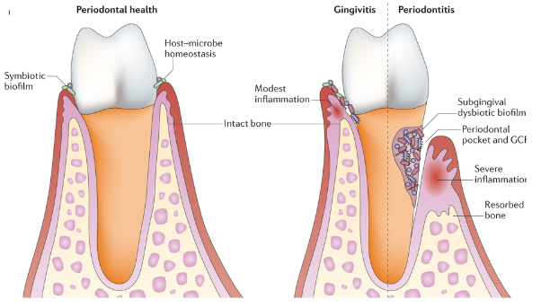 <ol><li><p>Periodontal disease is a disease resulting from an inflammatory response to a microbial challenge</p></li><li><p>The challenge is initiated by bacteria that accumulate on the tooth surface above the gum forming plaque</p></li><li><p>There is a distinct progression to disease</p></li></ol><p></p><ul><li><p>The bacteria is known to be inflammophilic</p></li><li><p>The host responds it the dysbiotic biofilm through an inflammatory response, this leads to tissue and osseous support destruction</p></li></ul><p></p><p>*look at picture to see the difference between normal health, gingivitis, periodontitis</p>