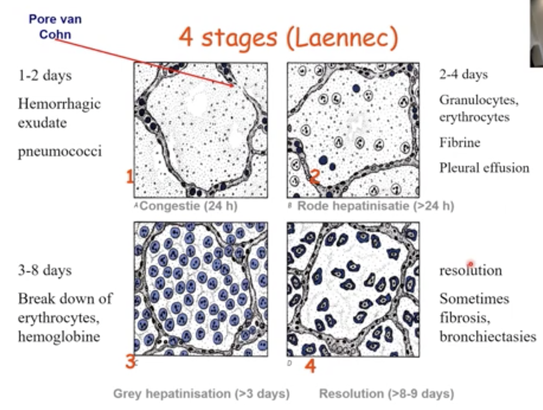 <p>1: 1-2 days Congestion</p><p>2: 2-4 days Red hepatization</p><p>3: 3-8 days Grey hepatization</p><p>4: Resolution (immune cells clear the infection)</p>