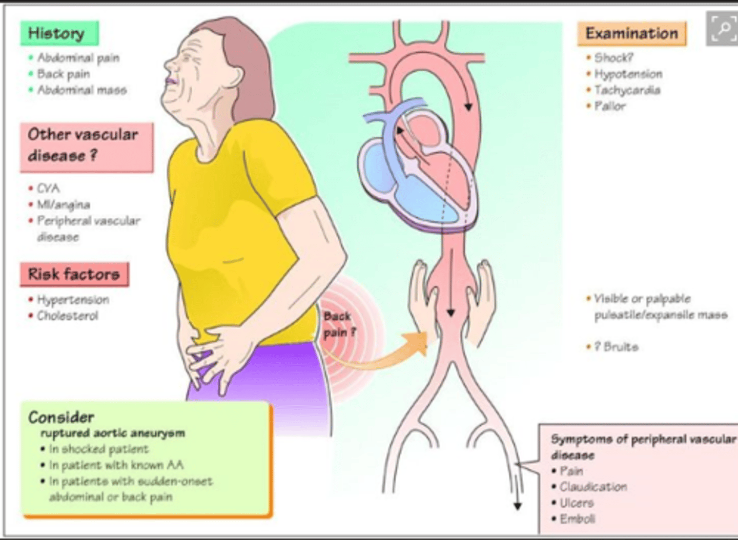<p>C</p><p>Most aortic aneurysms are palpable during routine examination and feel like a pulsating mass. A bruit will be audible, and femoral pulses are present but decreased. Such aneurysms are located in the upper abdomen just to the left of midline.</p>