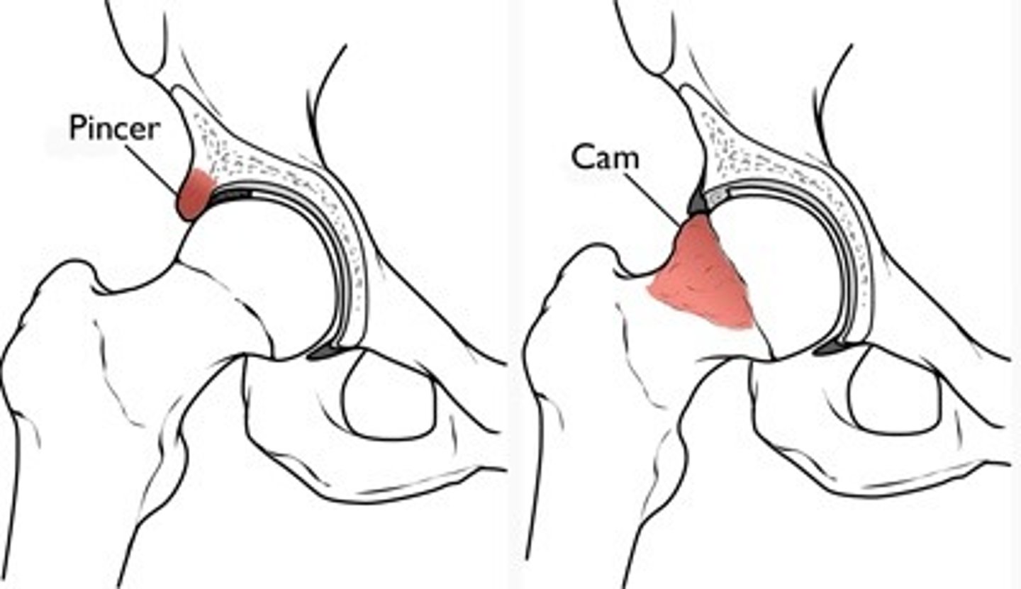 <p>impingement between the femoral head/neck and acetabular rim</p><p>*occurs secondary to previous hip trauma/pathology with boney overgrowth (osteophytes)</p><p>TYPES:</p><p>1. cam</p><p>2. pincer</p><p>*most individuals have a combo of both</p>