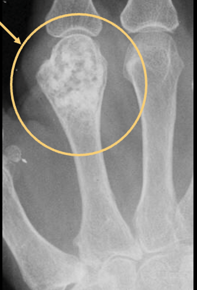 <p>ID feature of solitary enchondroma</p>