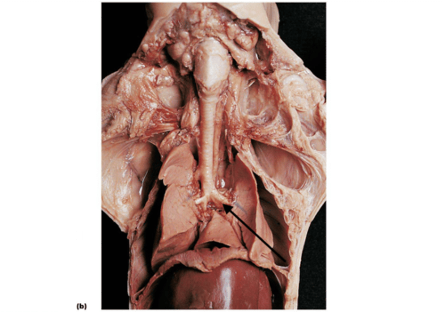 <p>Left primary bronchus</p>
