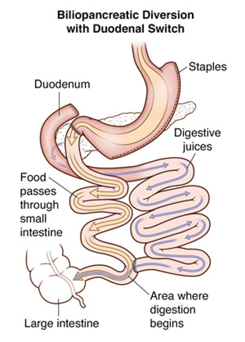 <p>- Mechanism = restriction, malabsorption, and gastric hormonal changes</p><p>- Irreversible</p><p>- More invasive</p><p>- Slightly more effective than RYBG method, but more complications</p>