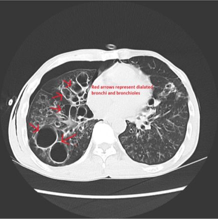 <p>CT Chest IV Contrast</p>