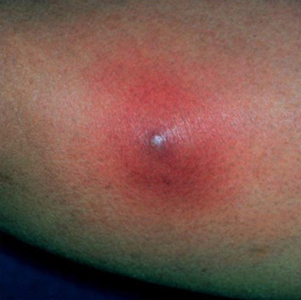 <p>infection</p>