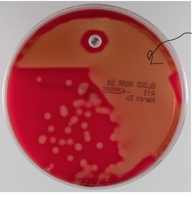 <ul><li><p>complete destruction of RBCs (get clear zones around colonies)</p></li><li><p>group A and B strep</p></li><li><p>sensitive to bacitracin</p></li><li><p>pathogenic and 50% are carriers</p></li><li><p>can cause step throat and scarlet fever</p></li><li><p>can cause flesh eating necrotizing fasciitis and form of toxic shock</p></li></ul><p></p>