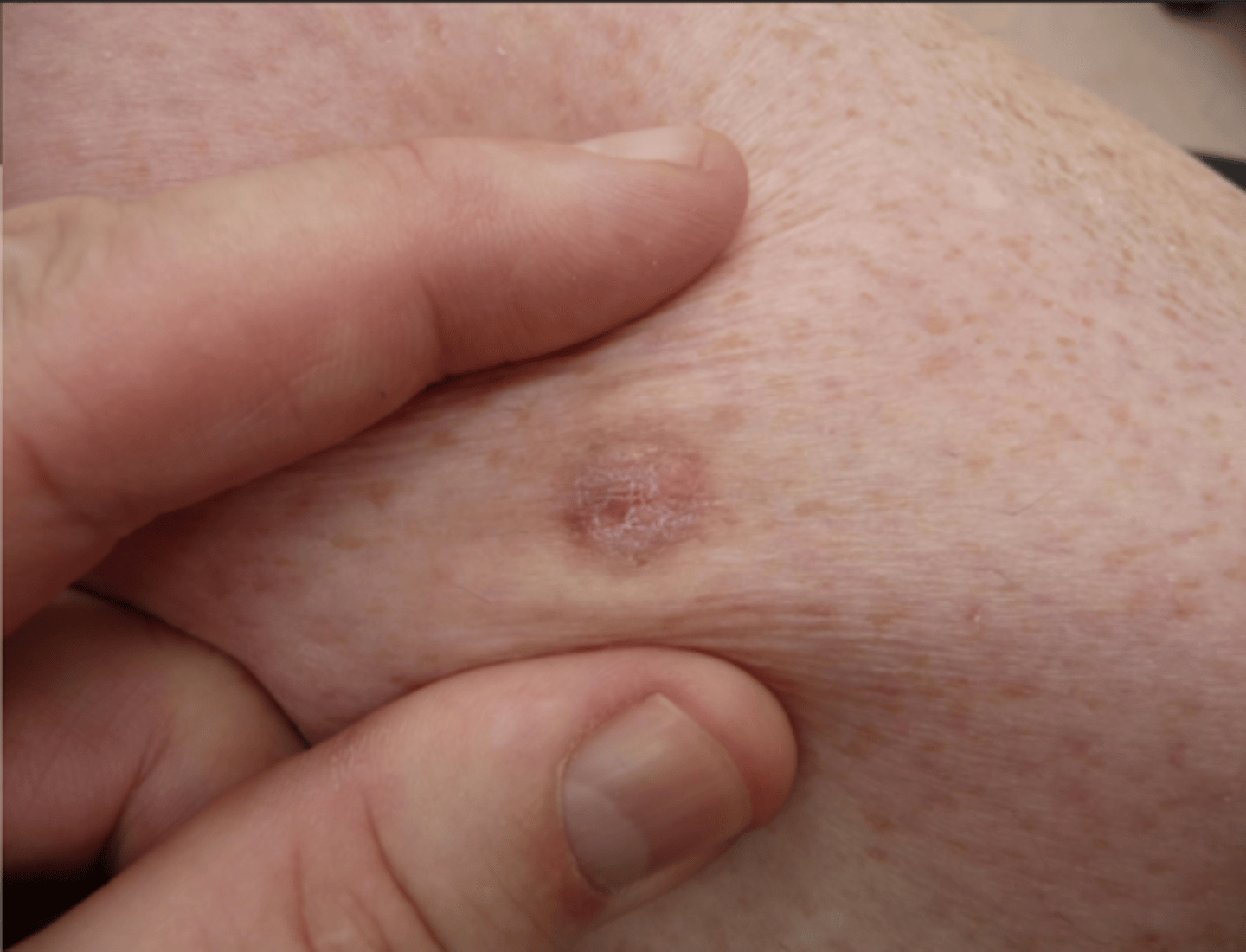 <p>Hoe kunnen we onze hypothese van dermatofibroom testen?</p><p>= laterale druk uitoefenen waardoor letsel naar beneden geduwd wordt is een typisch beeld voor?</p>
