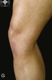 <p>Identify the pes anserine tendon attachment.</p>