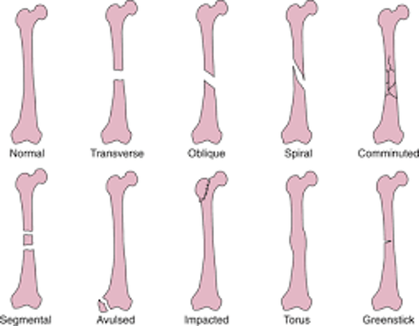 <p>fracture pattern</p>
