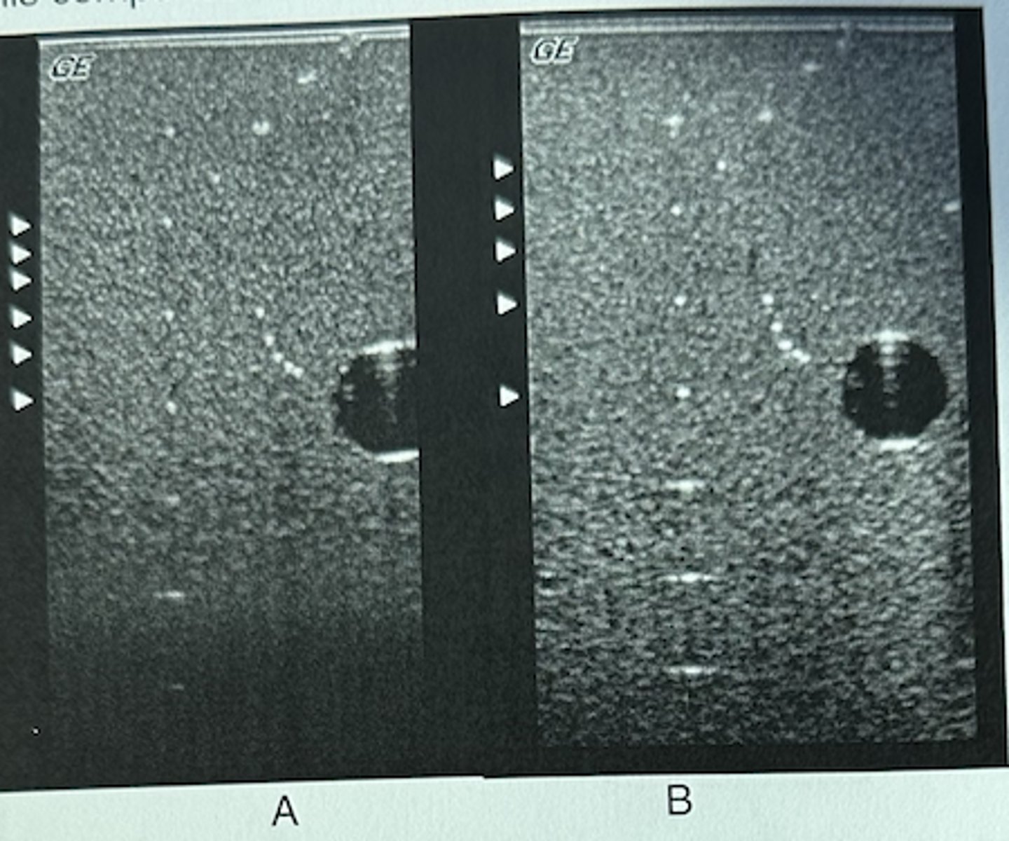 <p>These two phantom images were obtained with maximum gain and acoustic power using two different transducers. What information can be obtained by</p><p>this comparison?</p><p>A. Transducer A has less penetration than transducer B</p><p>B. Lateral resolution is best with transducer B.</p><p>C. Axial resolution is best with transducer B.</p><p>D. B and C only</p><p>E. All of the above</p>