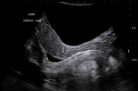 <p>It is located between the rectum and uterus and is also called the____________?</p>