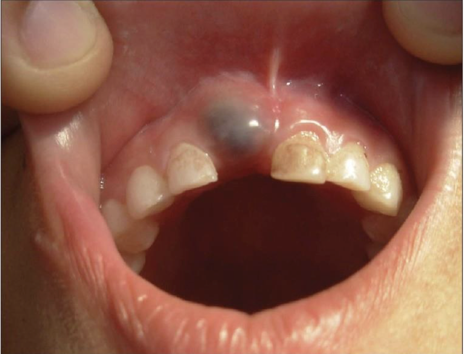 <p>12-year old male patient, which presented as a swelling involving the gingiva in the region of 11 of 5 year duration</p>