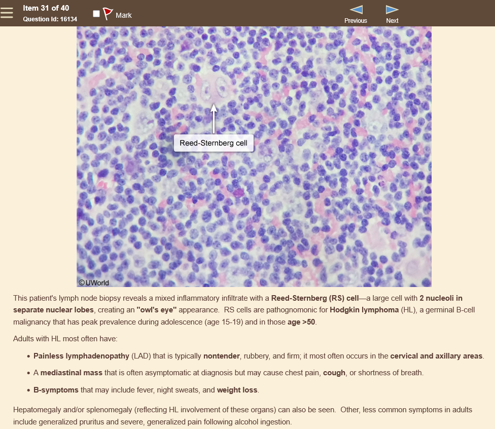 <p><strong>hodgkin lymphoma</strong> - germinal b cell lymphoma</p><p></p><p>reed-sternberg cell on biopsy (2 nucleoli in separate nuclear lobes), <strong>owl’s eye </strong>appearance </p><p></p><p>get a pet scan</p>