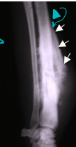 <ul><li><p><span style="color: red"><strong>MOA:</strong></span><u> </u><strong><u>metaphysis(end), mesenchymal: osteoid present</u></strong></p><ul><li><p>Bi-modal age distribution: <strong><u>&lt; 2y and &gt; 5y</u></strong></p></li><li><p><strong><u>Lg dogs:</u></strong> 75% in <strong><u>appendicular</u></strong></p><ul><li><p>often<strong> <u>away from the elbow, towards the knee</u></strong></p></li></ul></li><li><p><strong>Sm dogs: </strong>25% axal</p></li><li><p>Metastasis to<strong> lungs (diaphysis) - rarely show CS until end stage</strong></p></li></ul></li><li><p><span style="color: red"><strong>CS: </strong></span><strong>lameness, pain, </strong>dysphagia, exophthalmos, facial deformity, nasal discharge, paresis/paralysis, tenesmus</p></li><li><p><span style="color: red"><strong>ID:</strong></span> <strong>#1 rads:</strong> (<strong><u>Codman’s triangle, don’t cross the joint)</u></strong>, aspirate(rule out), biopsy</p></li><li><p><span style="color: red"><strong>DDX:</strong></span><strong> <u>fungal</u></strong></p></li><li><p><span style="color: red"><strong>TX:</strong></span><strong> <u>amputation </u></strong>(palliative),<strong> <u>pain</u></strong> meds, allograft, implants, <u>Chemo</u> (Doxorubicin or Carboplatin + doxorubicin), <u>radiatio</u>n (Tele or brachy): pain control, Bisphosphanates</p><ul><li><p><strong>Good prognosis: </strong>mandibular, perosteal</p></li><li><p><strong>Poor prognosis: </strong>maxilla, ribs, scapula, spine, prox humerus, telangiectic, high ALP</p></li></ul></li></ul><p></p>