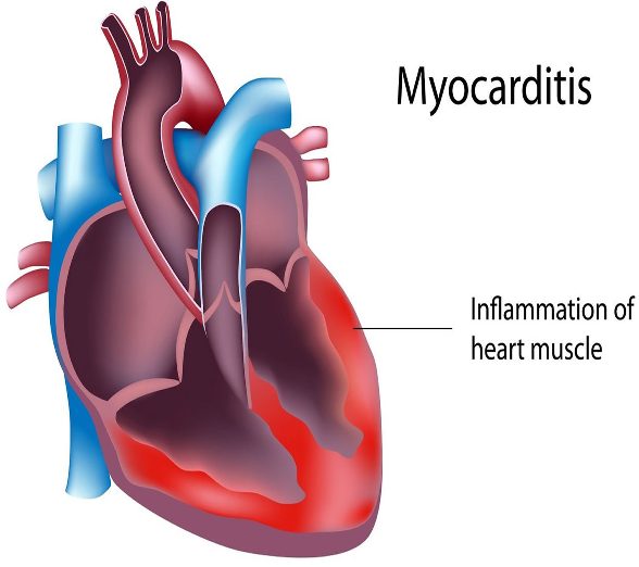 <p>inflammation of the heart muscle (myocardium)<span><span>.</span></span></p><p><span><span>This can reduce contractility → ↓ cardiac output.</span></span></p>