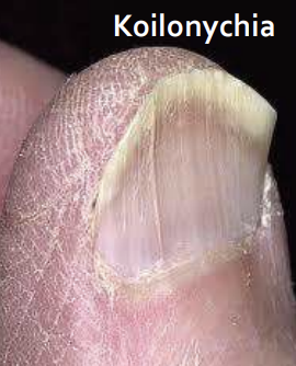 <p>Koilonychia: thin, concave nails, raised edges (spoon-shaped)</p>