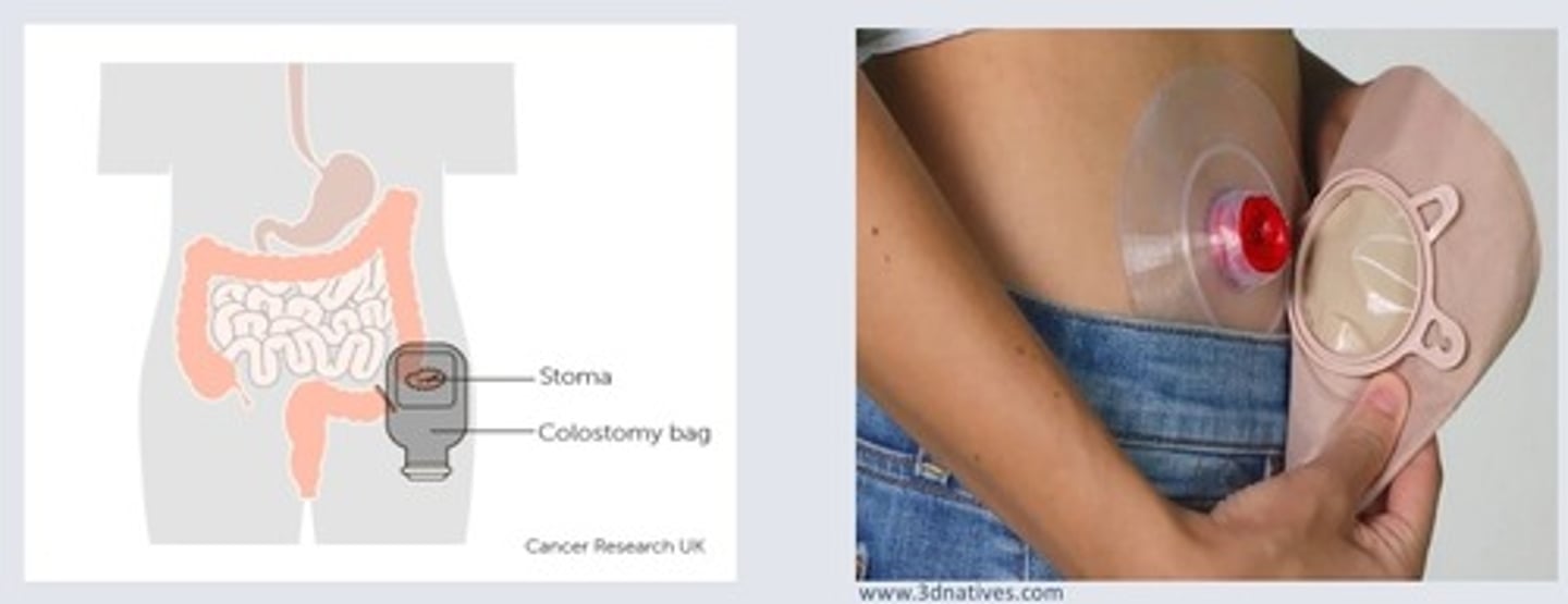 <p>a surgically created opening to reroute a body pathway to outside of the body</p>