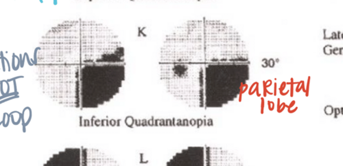 <p>What would be the VF defect if the optic radiations through the left parietal lobe were cut?</p>