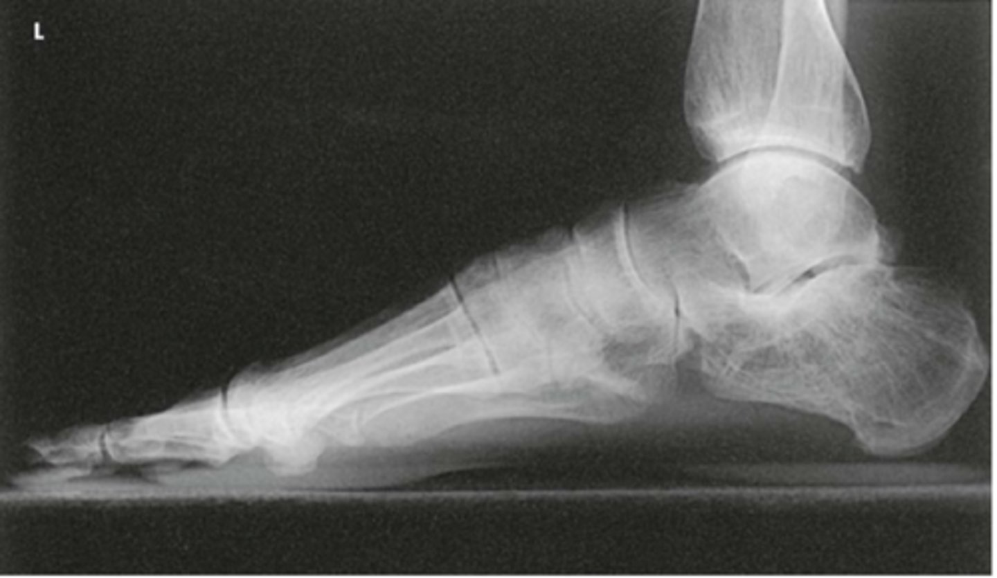 <p>- True lateral</p><p>- CR to midcuneiform (base of third MT)</p><p>- Entire foot visualized</p><p>- Metatarsals superimposed</p><p>- Optimal exposure factors</p>