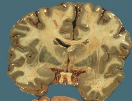 <ul><li><p>green discoloration of brain</p></li><li><p>exposure by proximity to waste water treatment facilities, landfills and farms with manure storage</p></li></ul><p></p>