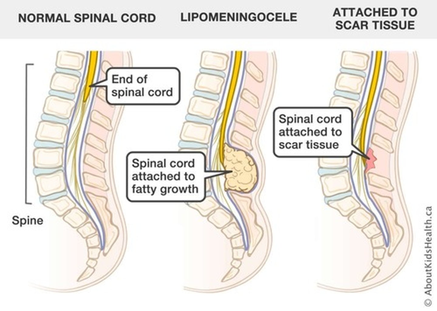 <p>- te kort vettig omgevormd filum terminale</p><p>- littekenweefsel herstelde meningomyelocoele</p><p>- verbinding conus en SC lipoom</p>