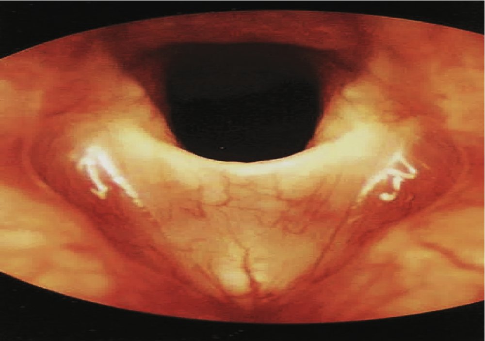 <p>sheet of tissue over the vocal folds, that can grow back if removed</p><p>stridor, shortness of breath, difficulty swallowing, weak cry in infants, higher pitch</p>