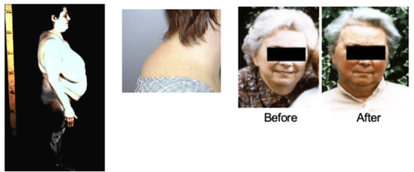 <p>Clinical features:</p><p>-- Rapid weight gain in trunk, and face, and growth of fat pads along the collarbone</p><p>-- Central obesity; buffalo hump; moon face</p><p>-- Easy bruising, skin atrophy and thinning</p><p>-- Acne</p><p>-- Hirsutism</p>