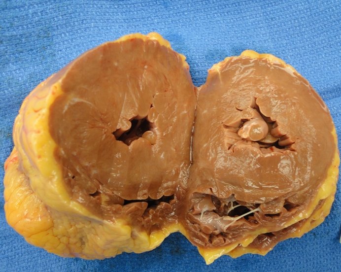 <p>emergency SOB, palpitation, pulmonary edema, afib with rapid ventricular response. Histology= thick myocardial fibers with large hyperchromatic nuclei and mild intersitiial fibrosis. autopsy shown. Diagnosis? </p>