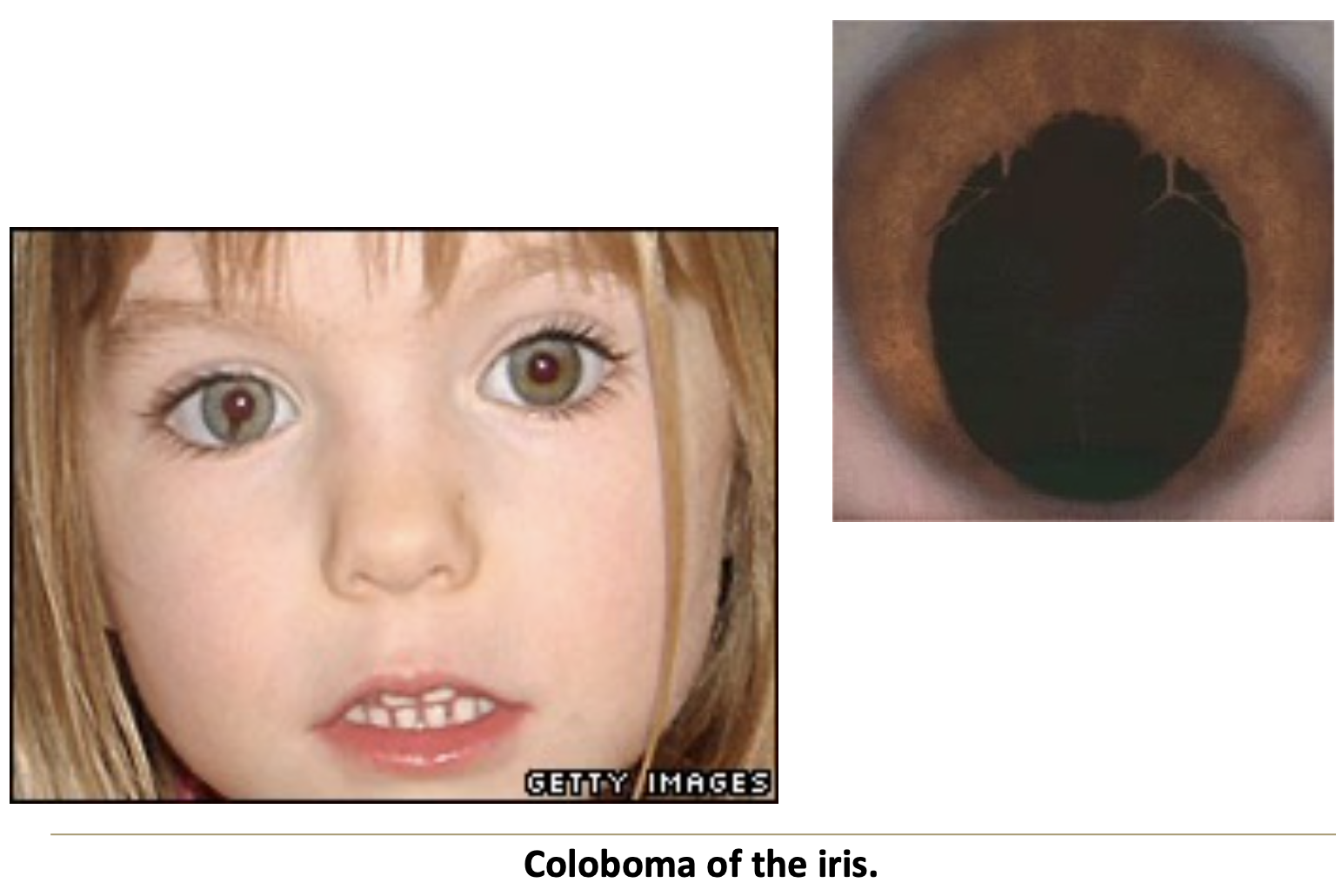 <p>A defect from failure of optic fissure to close; can be genetic and affect the retina, sclera, and ciliary body.</p>