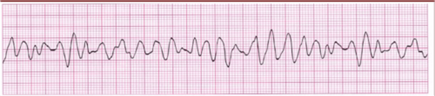 <p>Chopy but not as high as polymorphic V tach</p>