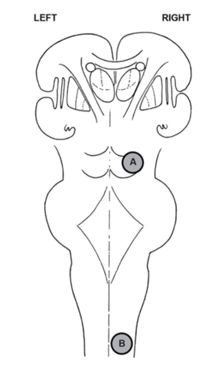 <p>Pain and Temperature: Left side</p><p>Touch and Pressure: Left side</p><p>Associative</p>