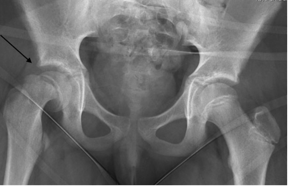<p><strong>disorder of proximal femoral physis causing slippage of the metaphysis relative to epiphysis, </strong>most commonly affecting <strong>adolescent hips 10-15yo </strong>in periods of frequent<strong> </strong>growth<strong> </strong><br><em>Risk Factors: </em><strong>AMAB</strong><span>&gt;AFAB, obesity, underlying endocrine disorders (hypothyroid)</span><br><br><span>S/S: <strong><u>knee pain</u></strong> due to activation of medial obturator nerve, <strong>pain in hip, groin, thigh, abnormal gait/limp</strong>, hip held in external rotation</span><br><br><span>Dx: XRAY (“ice cream scoop off cone”)</span><br><span>Tx:</span><strong> </strong><span><strong>percutaneous in situ fixation (surgery)</strong></span><br><em>Complications: </em><span>contralateral slip, early osteoarthritis, osteonecrosis of head in unstable</span><br><span style="color: red">**<em>DO NOT MISS!</em></span></p>