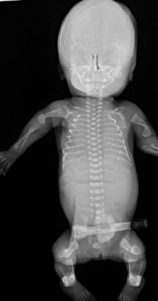 <ol><li><p>abnormally formed bones due to insufficiency or absent type I collagen production; most severe form is lethal</p><ol><li><p>short, bent limbs</p></li><li><p>multiple fractures</p></li><li><p>short, beaded ribs</p></li><li><p>reduction or absence of cranial vault ossification</p></li><li><p>blue sclera</p></li></ol></li></ol><p></p>