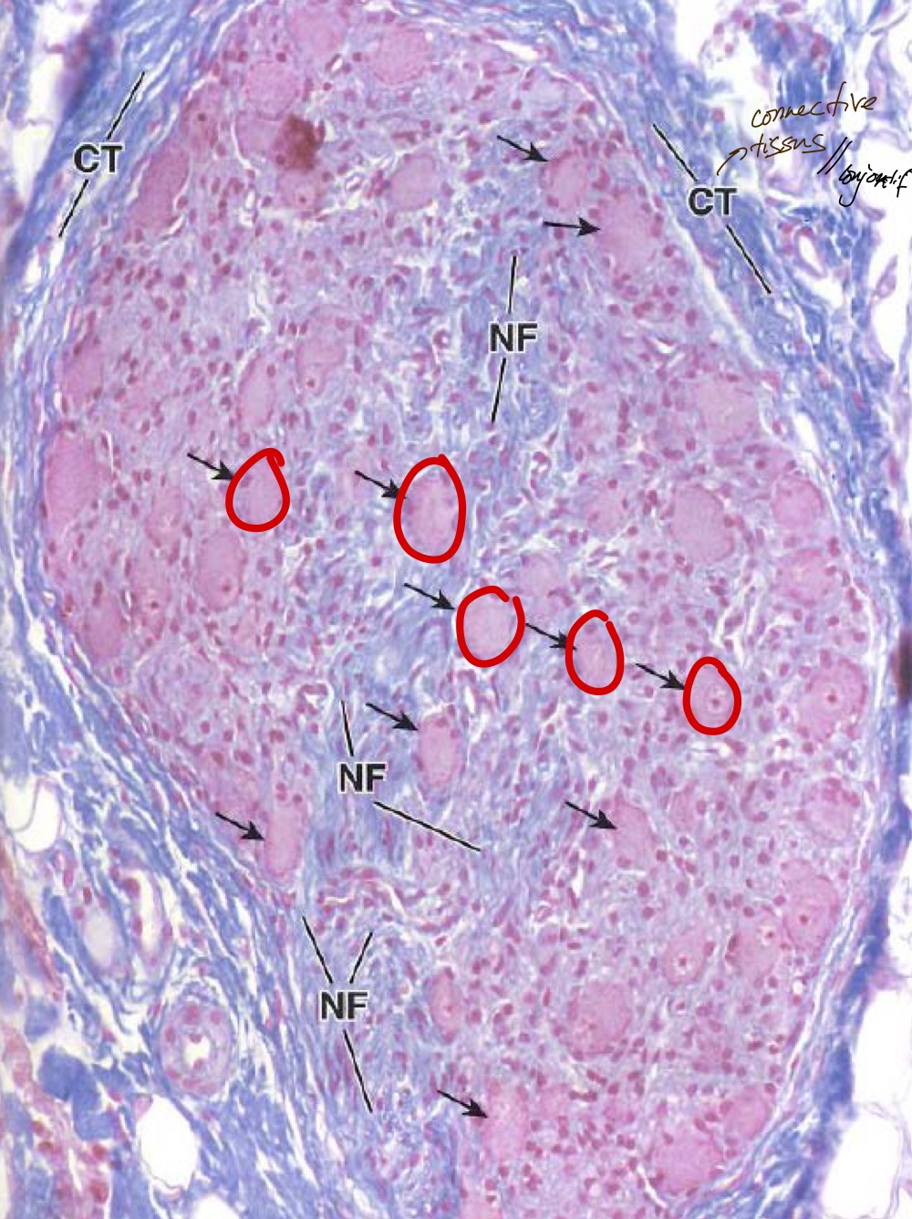 <p>MO, paraffine, TMB</p><p>Ganglions nerveux avec des collagènes de type 1 qui encombre les nerfs</p><p>Gros corps cellulaire (entouré en rouge)</p><p>TCNS dense irrégulier</p>