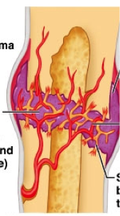 second stage of healing a bone fracture. growth of new capillaries into the clotted blood a the site of the damage and disposal dead tissue by phagocytes occurs. connective tissue cells of various types form internal and external masses of tissue repair to form the fibrocartilage callus.